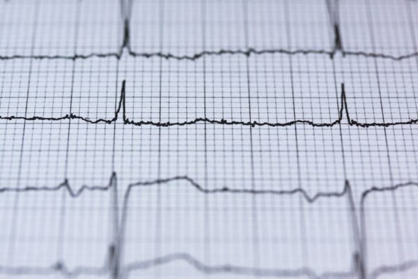 Cardiac examination - ECG static electrocardiogram