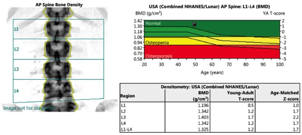 bone-densitometry-ap-spine