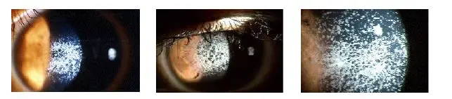 LASIK 手術後，症狀會迅速發展